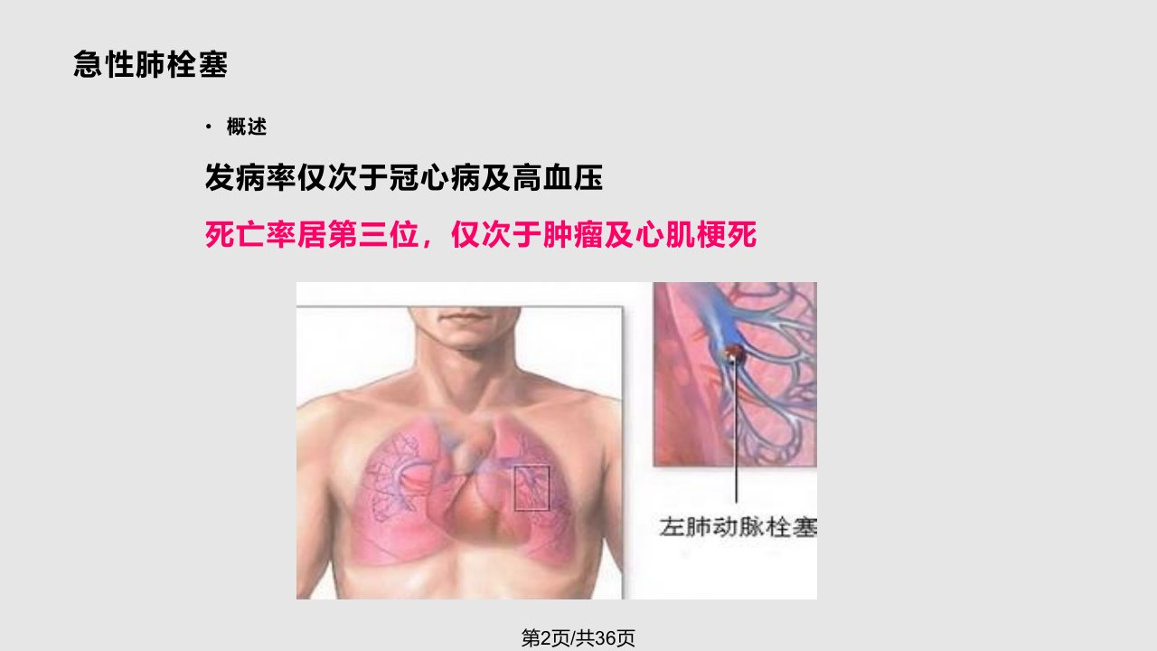 肺栓塞的急救