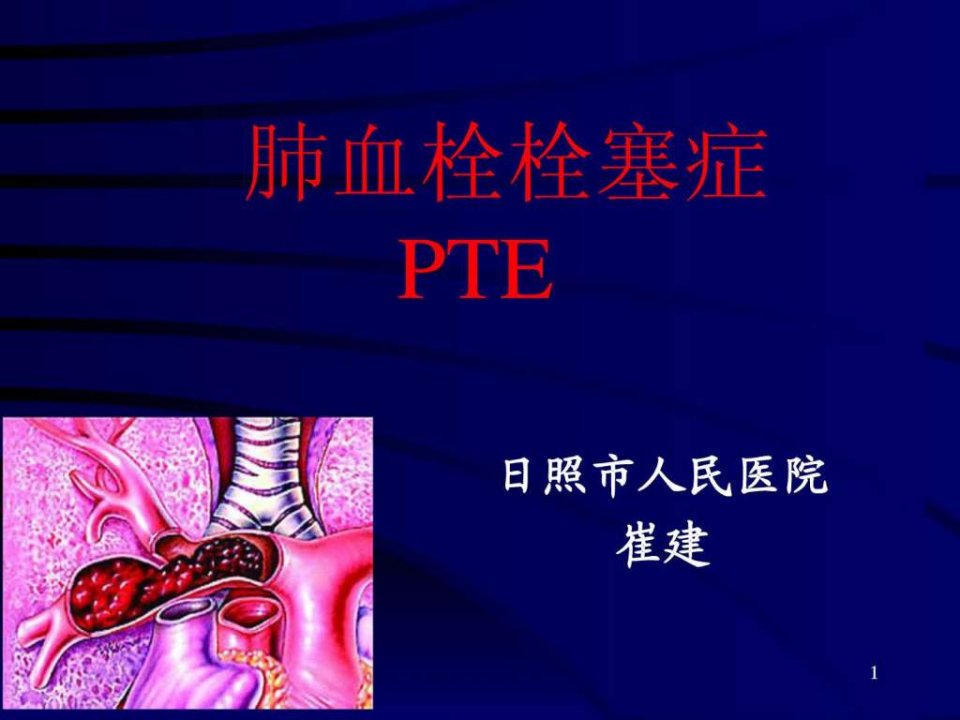 肺栓塞幻灯1205.ppt