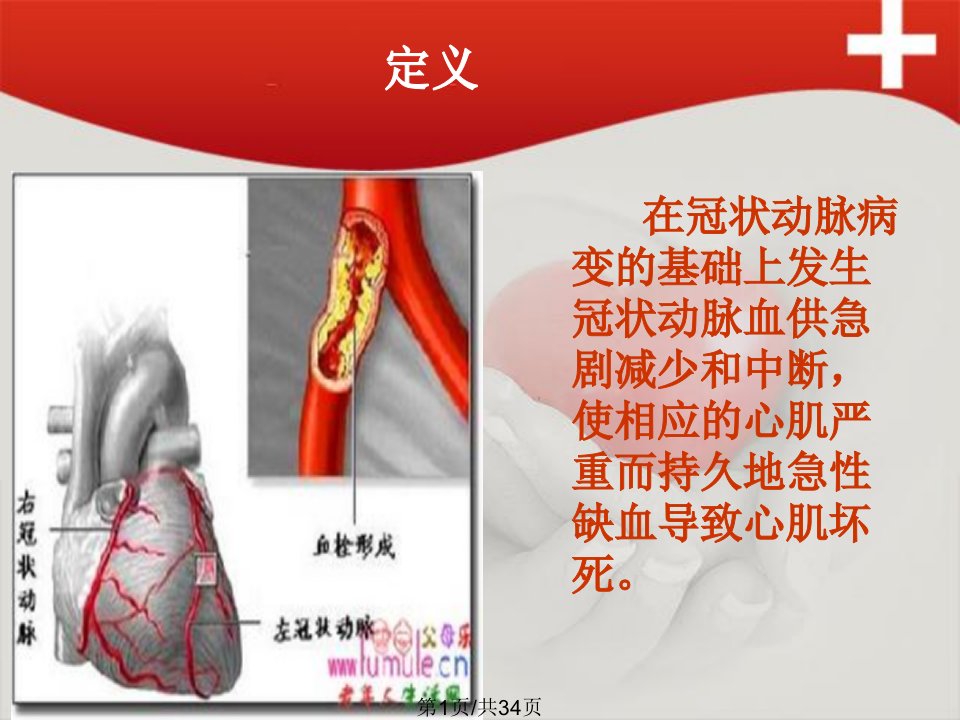 急性前壁心肌梗死护理查房