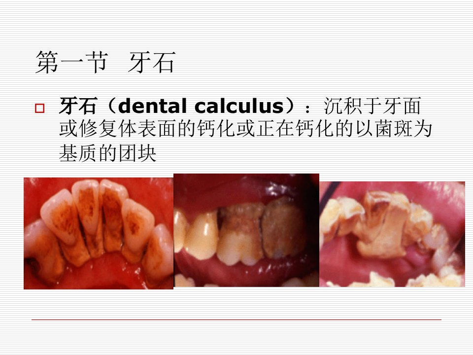 牙周病的局部促进因素讲义