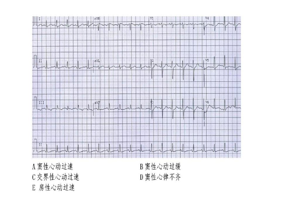 心电图练习题带图有答案