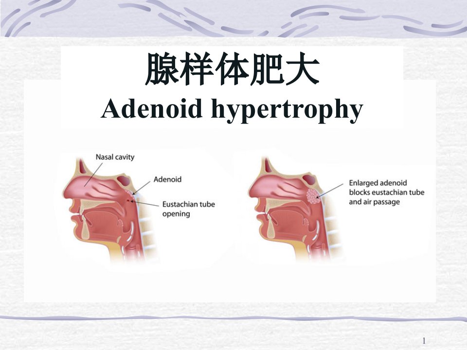 腺样体肥大ppt课件