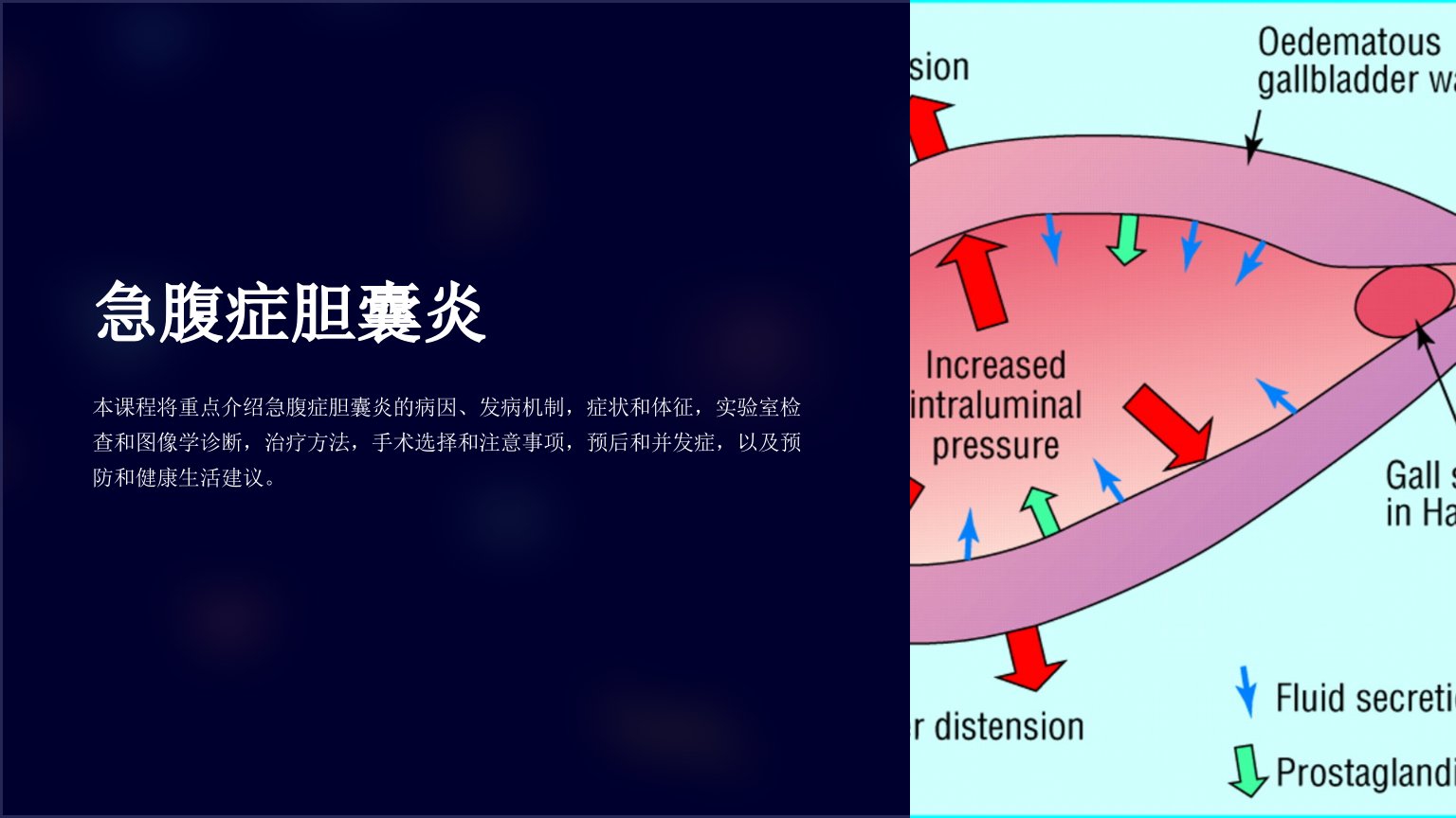 《急腹症胆囊炎》课件