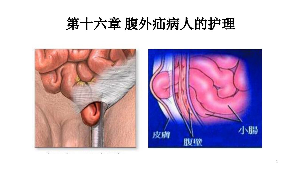 腹外疝病人的护理ppt课件