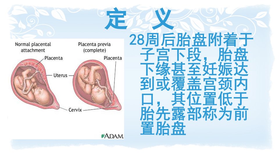 前置胎盘课件