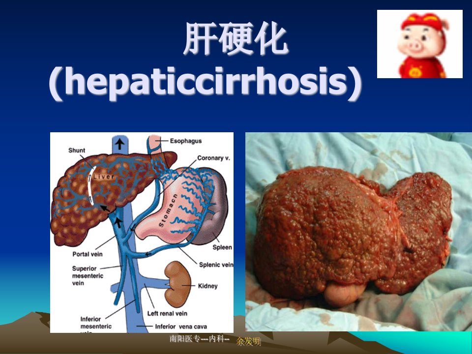 《肝硬化完整》PPT课件