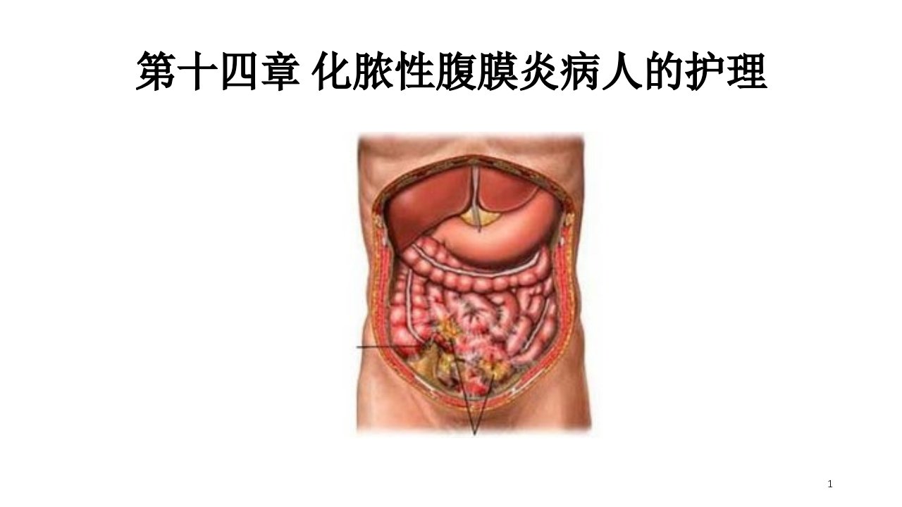 急性化脓性腹膜炎病人的护理ppt课件