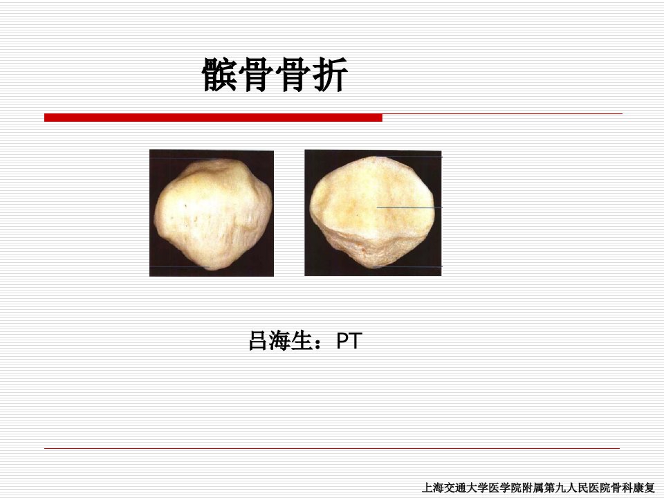 髌骨骨折康复