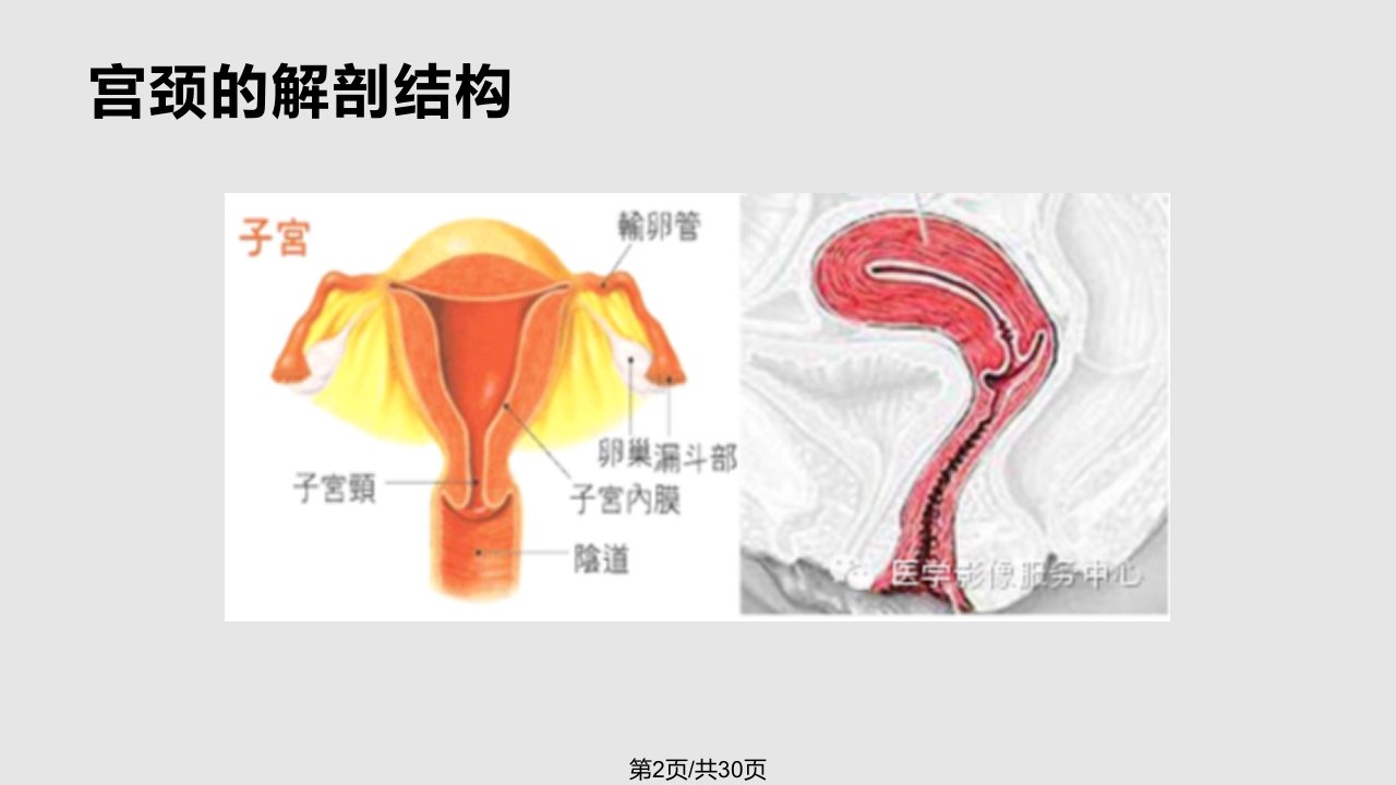 MRI在宫颈癌的临床应用