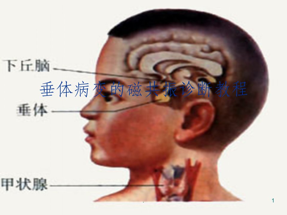 垂体病变的磁共振诊断教程