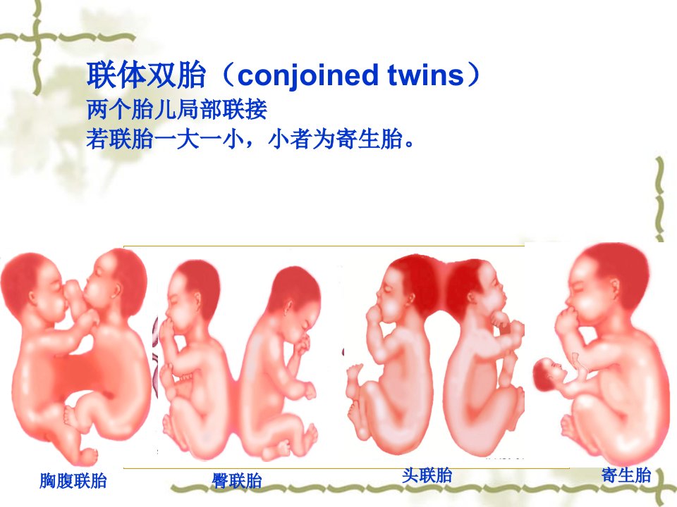 联体双胎妇产ppt培训课件