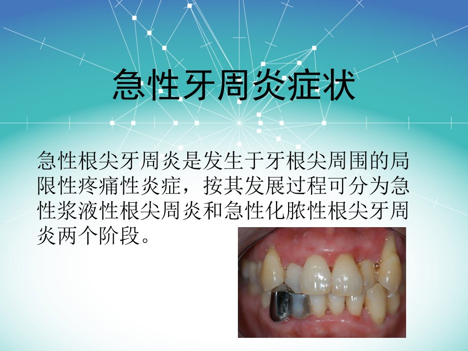 急性牙周炎症状