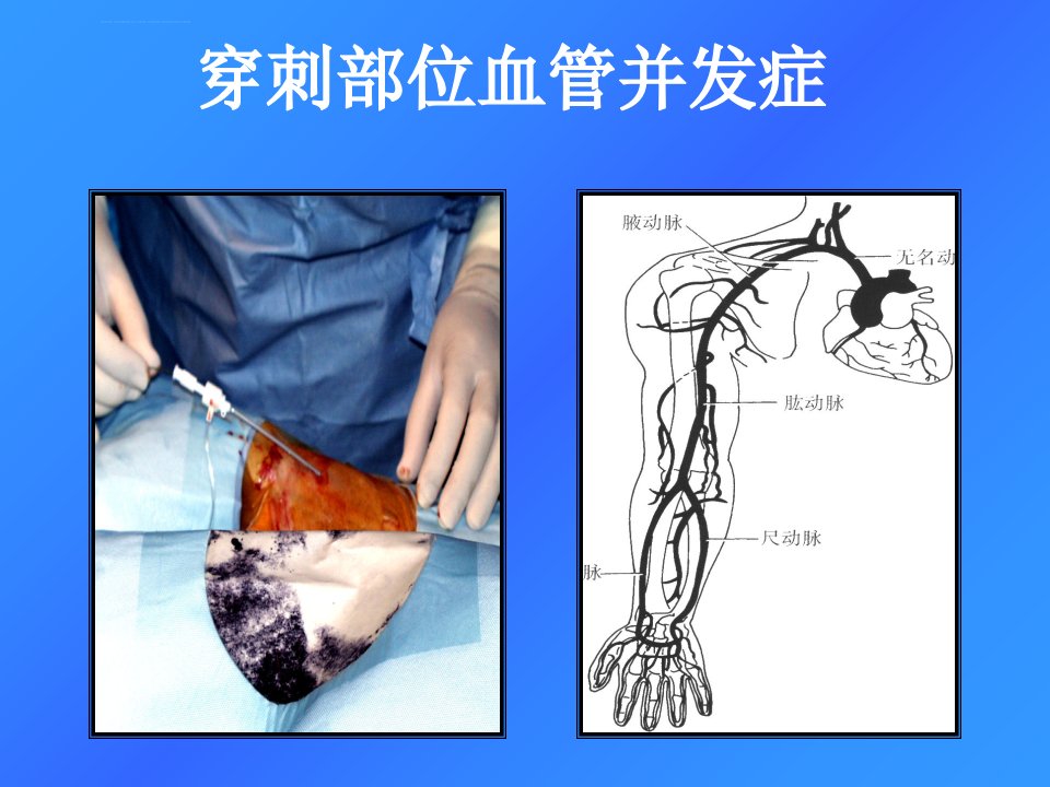 心脏介入治疗术后常见并发症预防与护理ppt课件