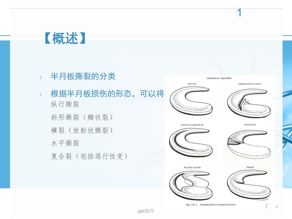 半月板撕裂的治疗ppt课件