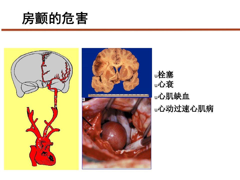 医学课件房颤抗凝的规范化治疗