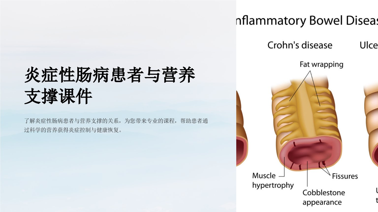 炎症性肠病患者与营养支撑课件