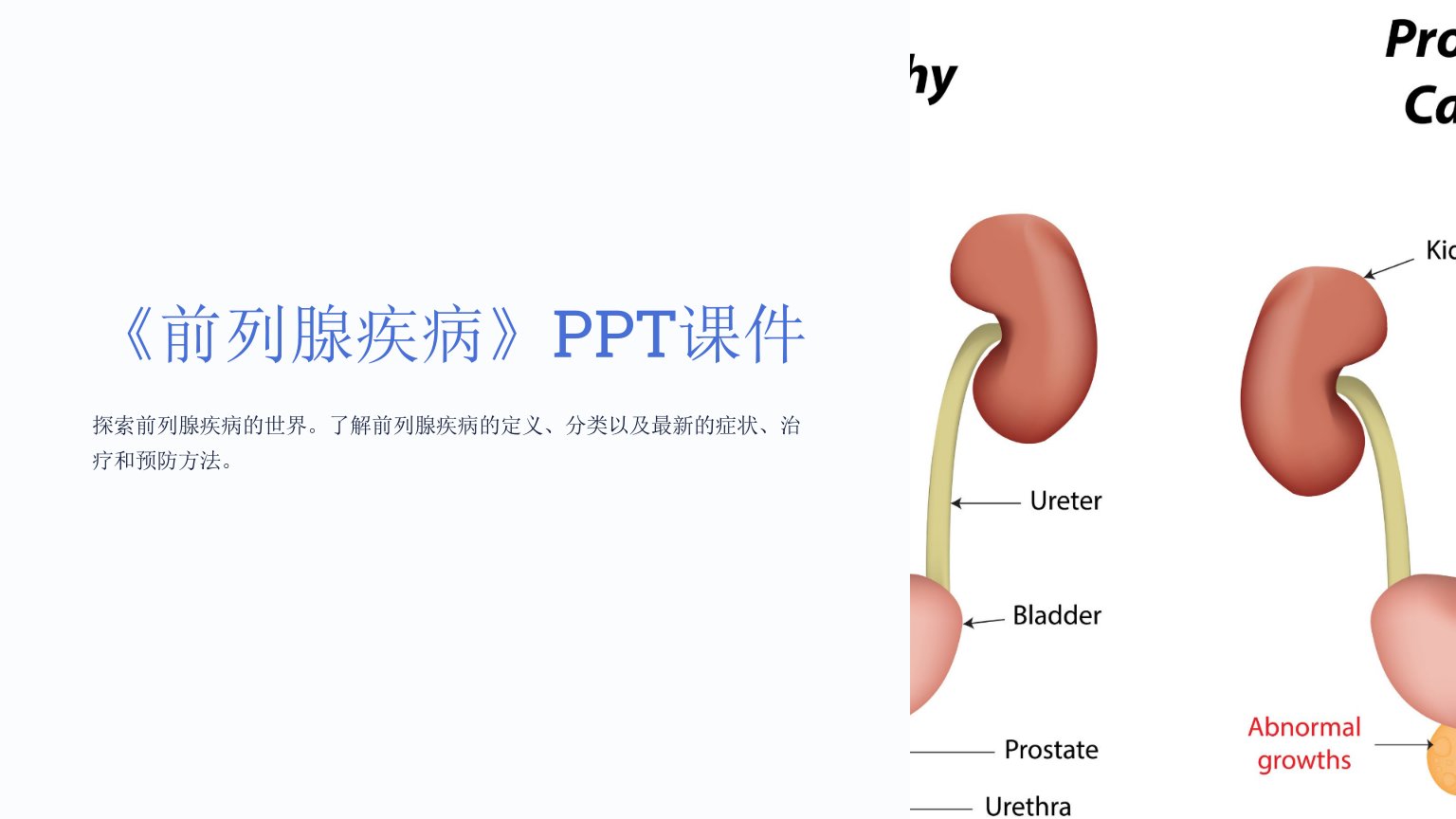 《前列腺疾病》课件