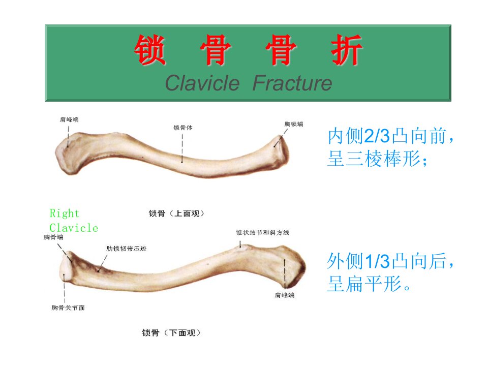 锁骨骨折幻灯片