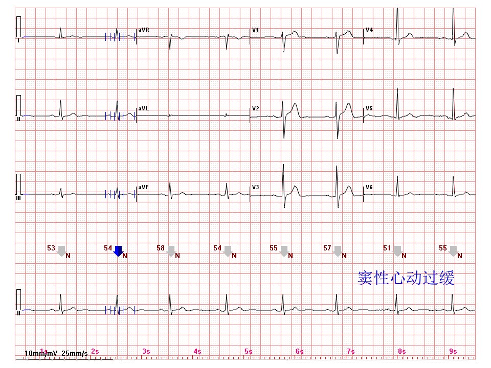 心电图常见正常和异常心电图图谱