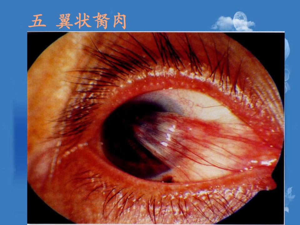 翼状胬肉及干眼症、眼外伤等