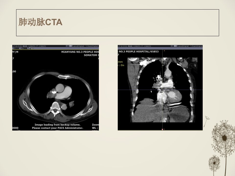 肺栓塞CT诊疗优质PPT课件