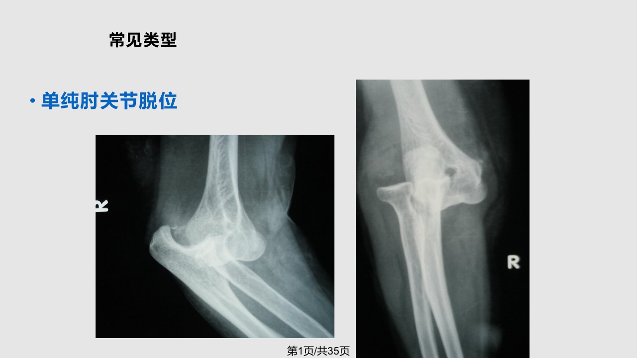 肘关节骨折脱位治疗经验总结1PPT课件