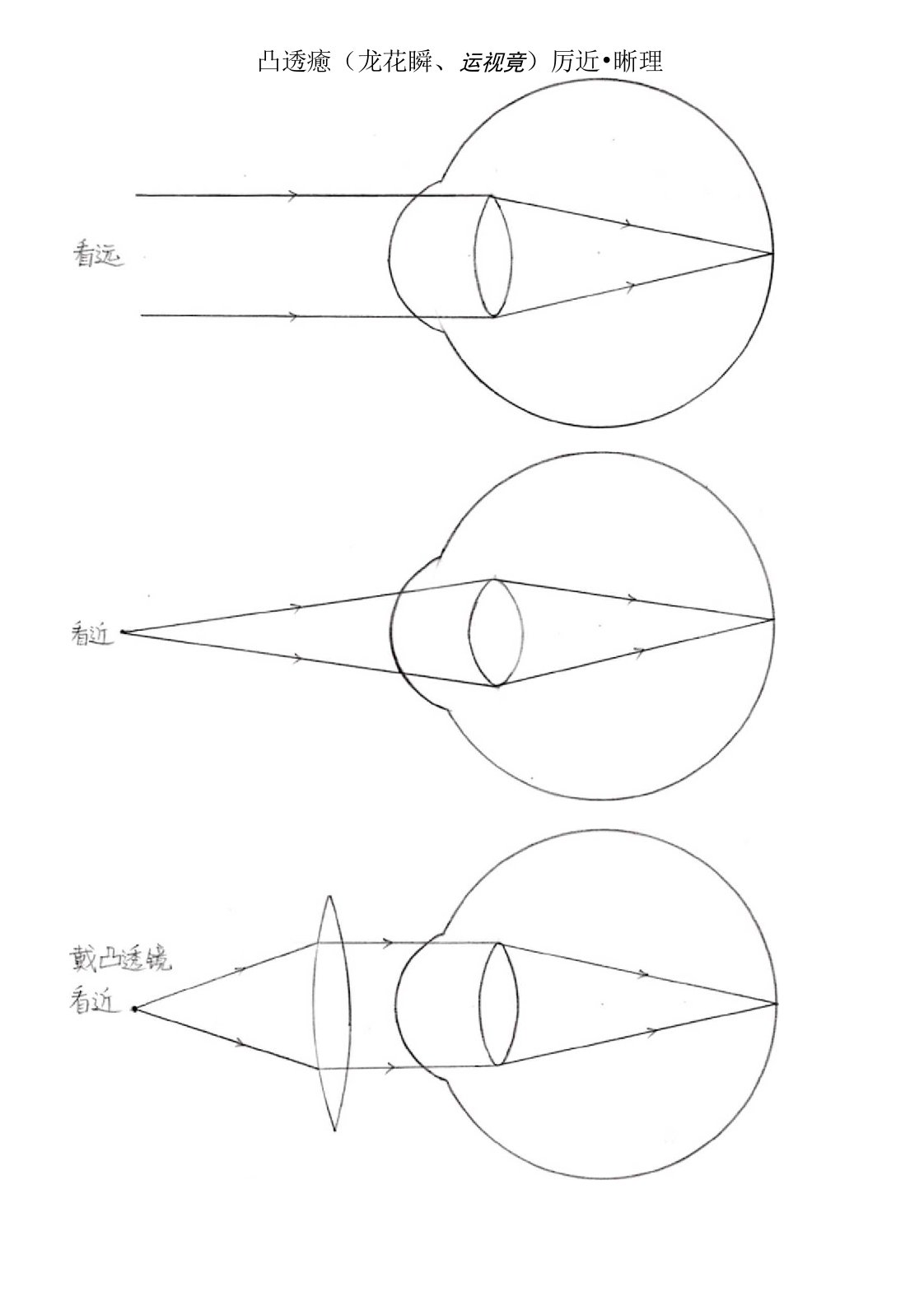 凸透镜防近视原理