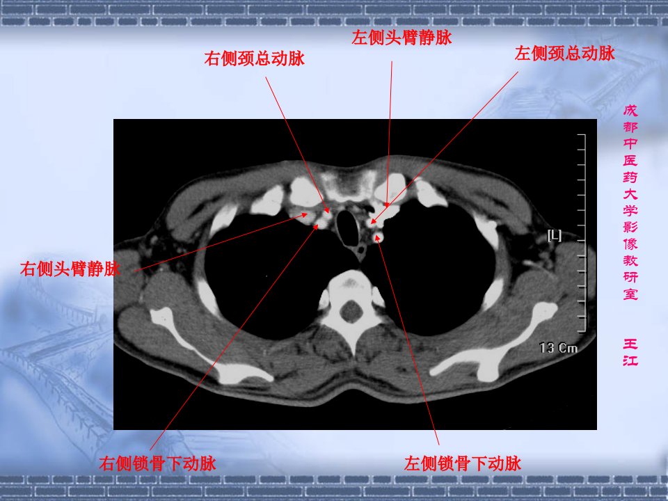 肺部CT-肺部纵隔窗