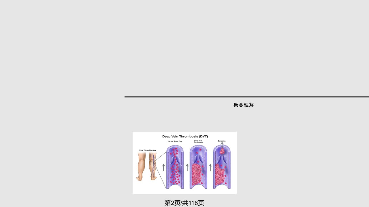 VTE的预防和治疗