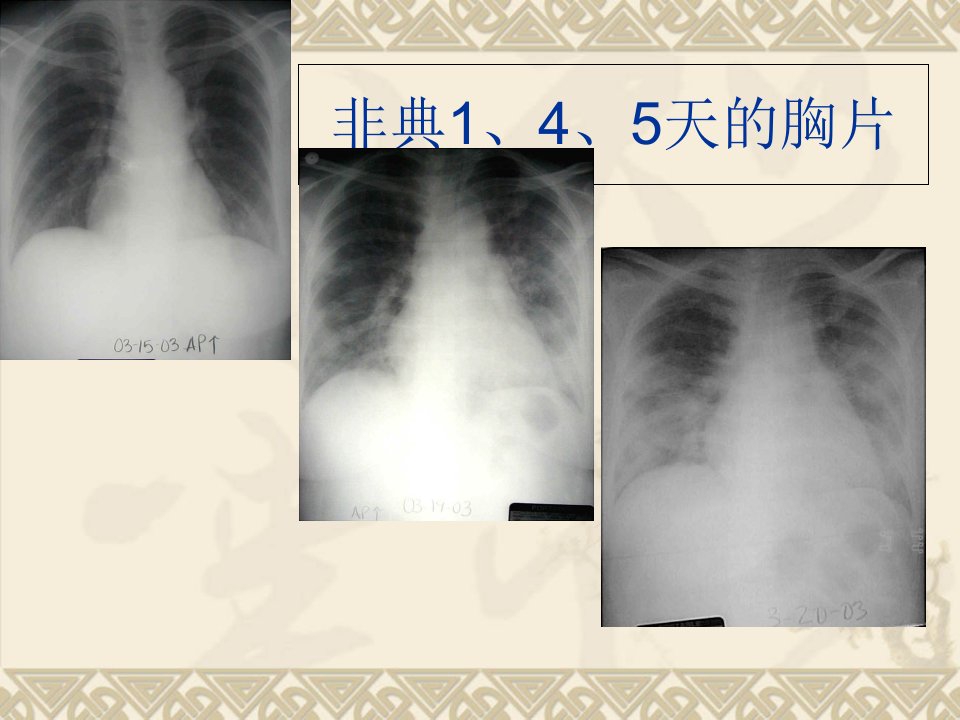 呼吸机的急诊应用