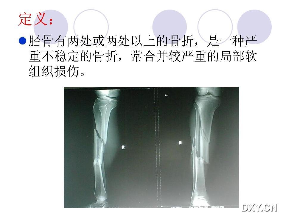 最新多节段胫骨骨折的治疗PPT课件