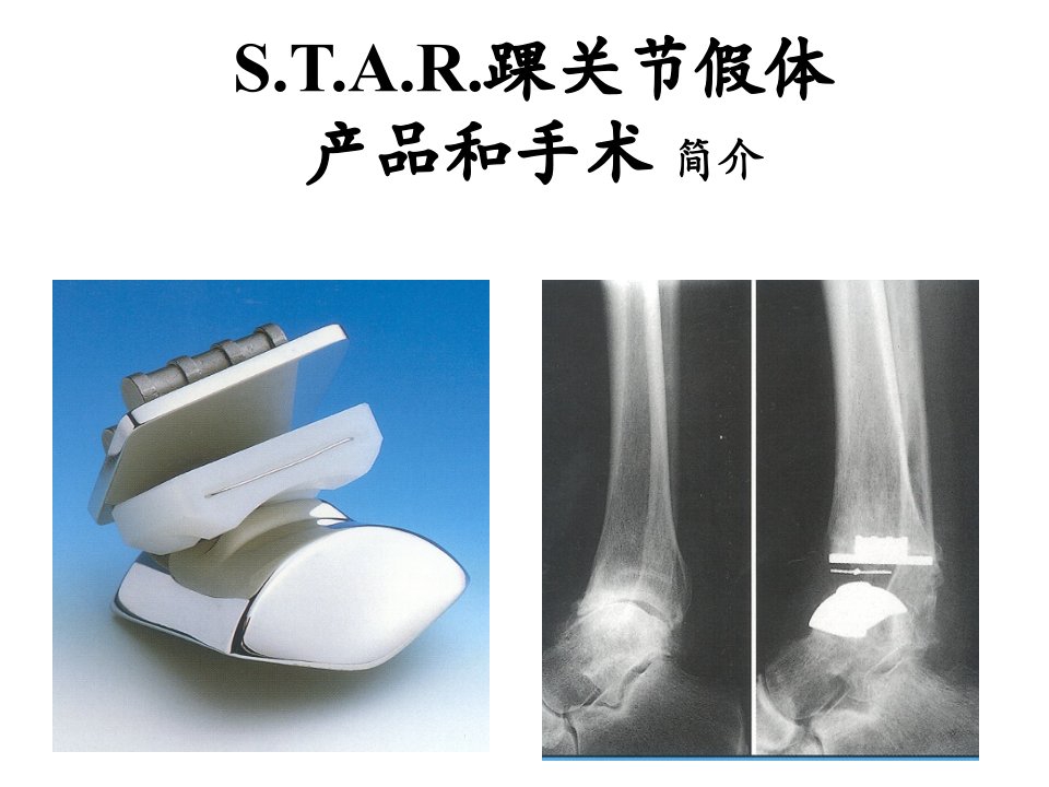 踝关节置换手术步骤