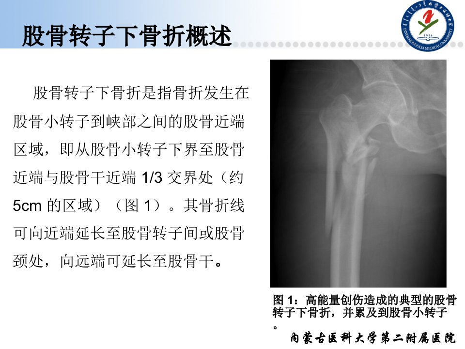 临床综述股骨转子下骨折诊疗进展王喜良