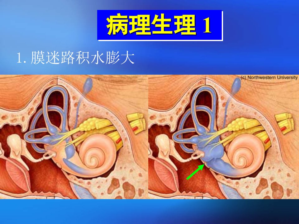 医学专题梅尼埃病七年制