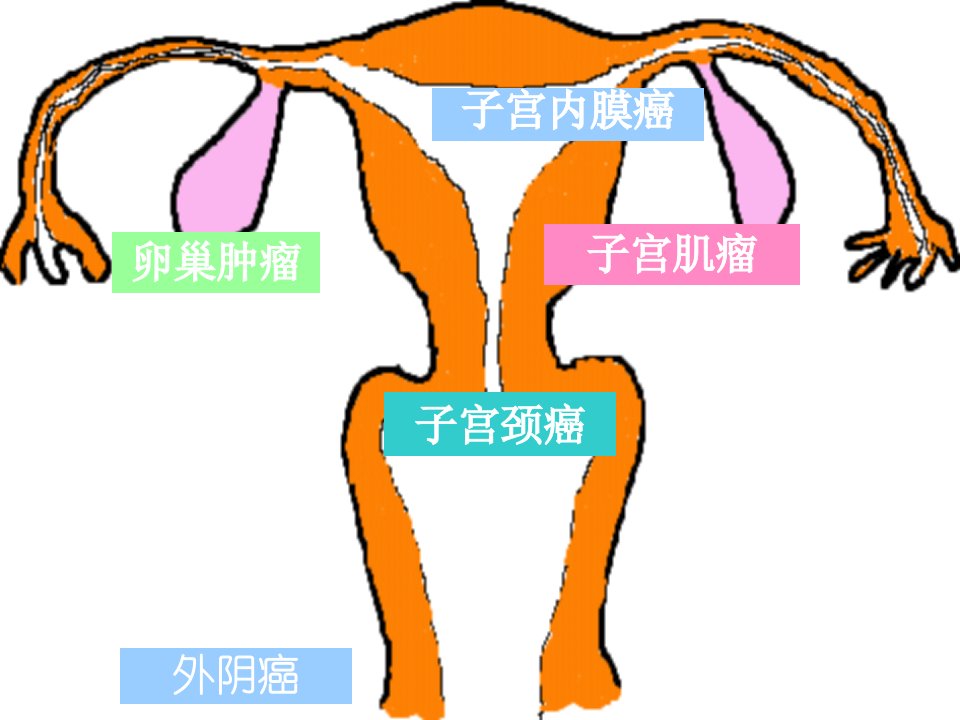 最新子宫内膜癌妇科知识PPT课件