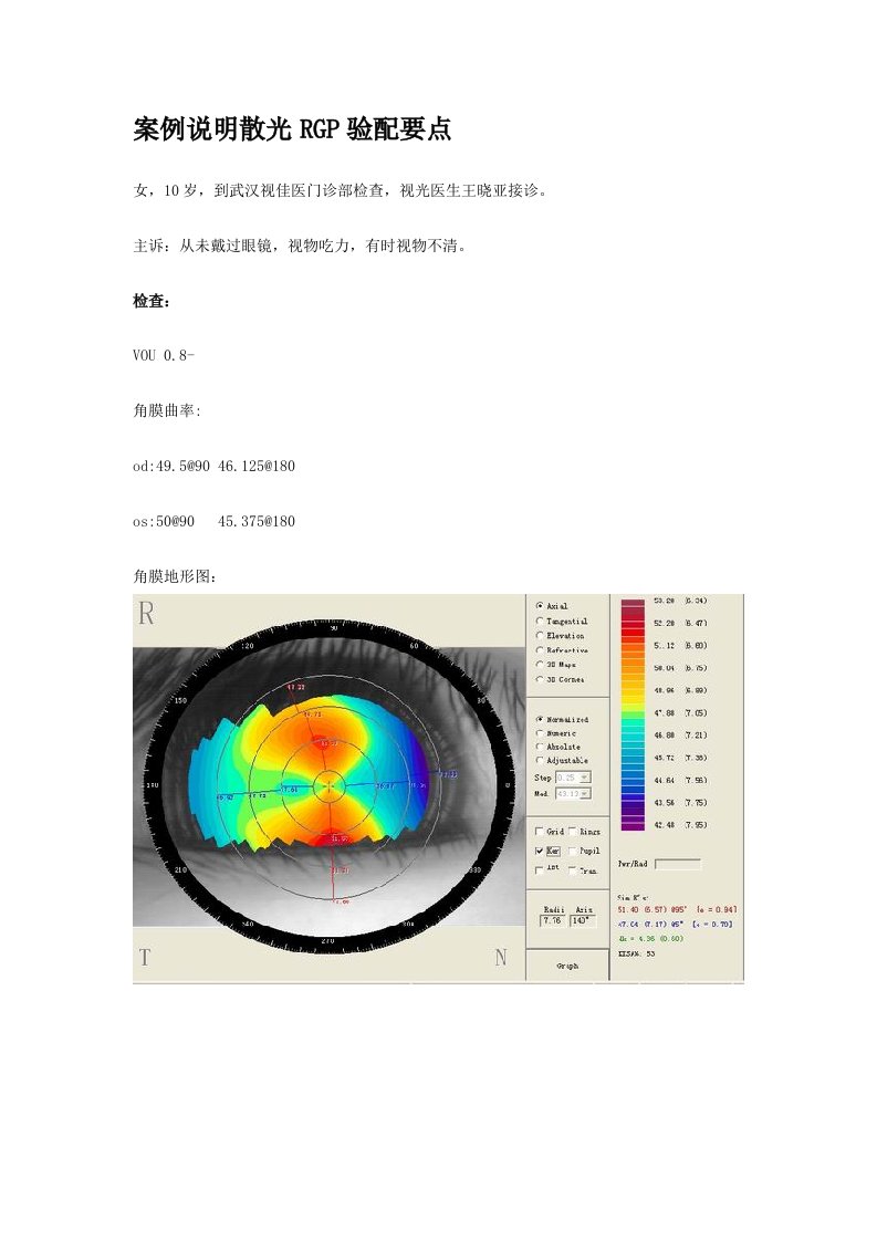 案例说明散光rgp验配要点