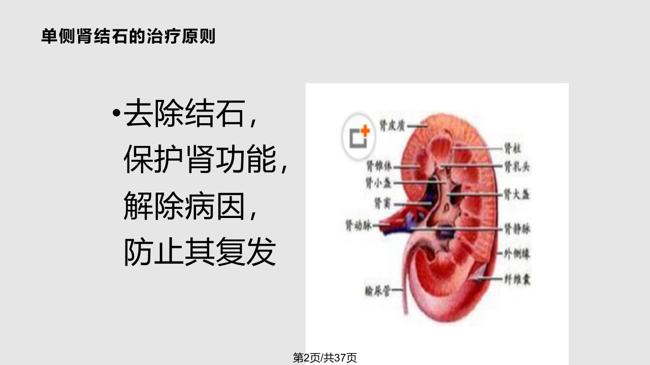 泌尿系结石的治疗