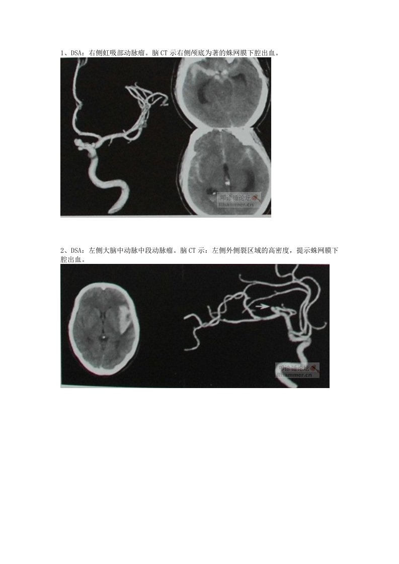 不同部位所致蛛网膜下腔出血的头颅CT表现