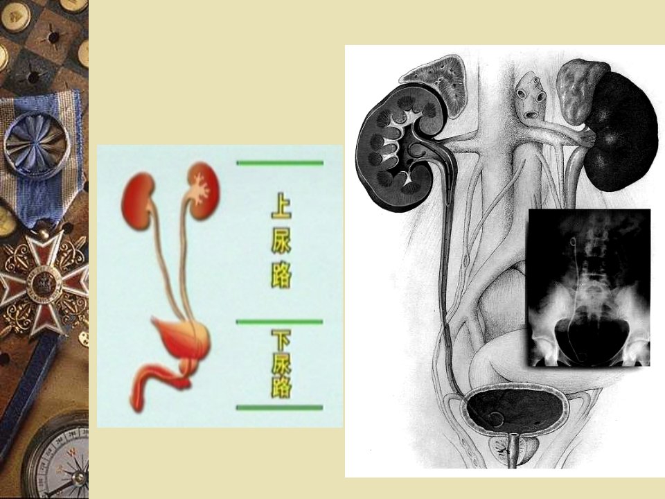 医学专题泌尿系结石梗阻