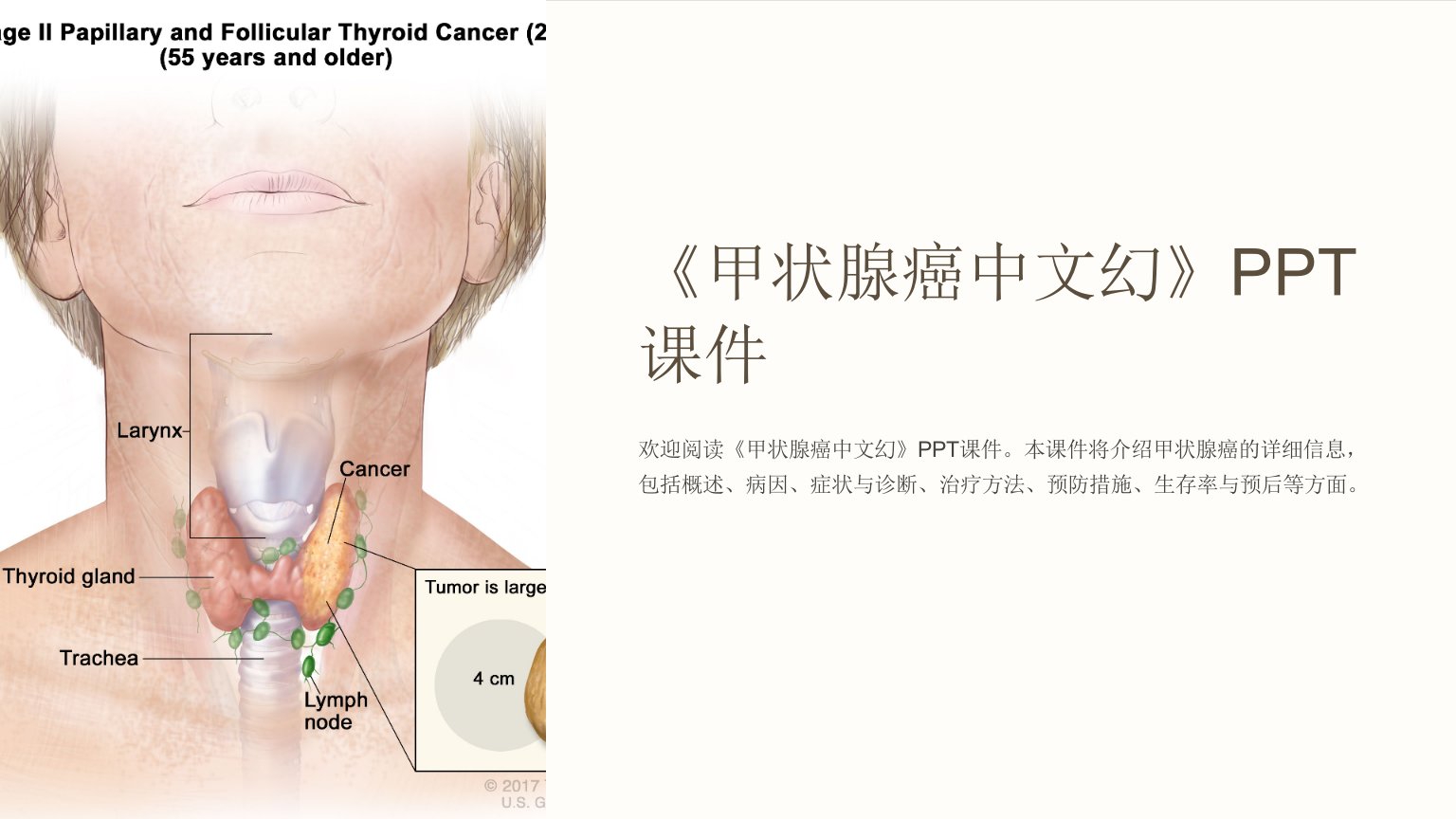 《甲状腺癌中文幻》课件