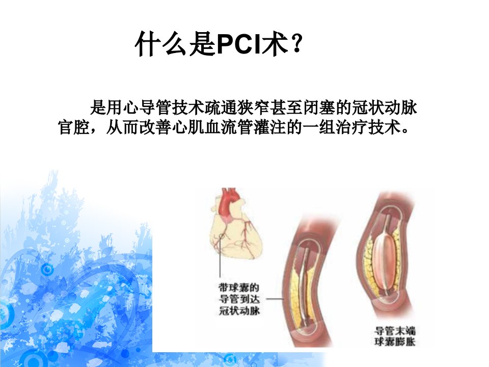 pci术前术后的护理ppt课件