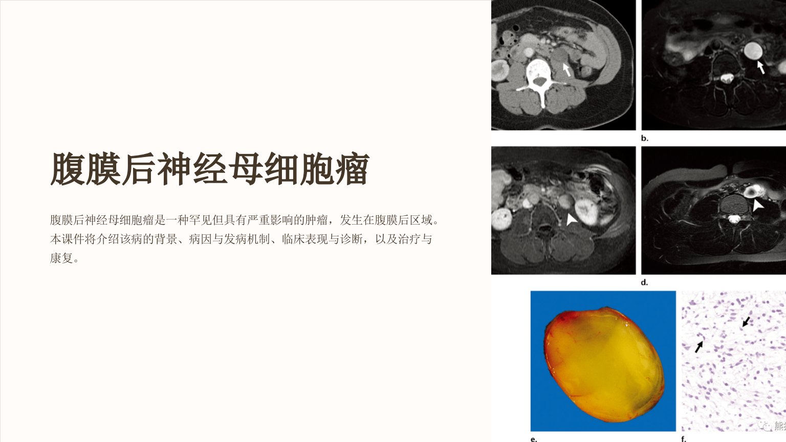 腹膜后神经母细胞瘤修改版课件