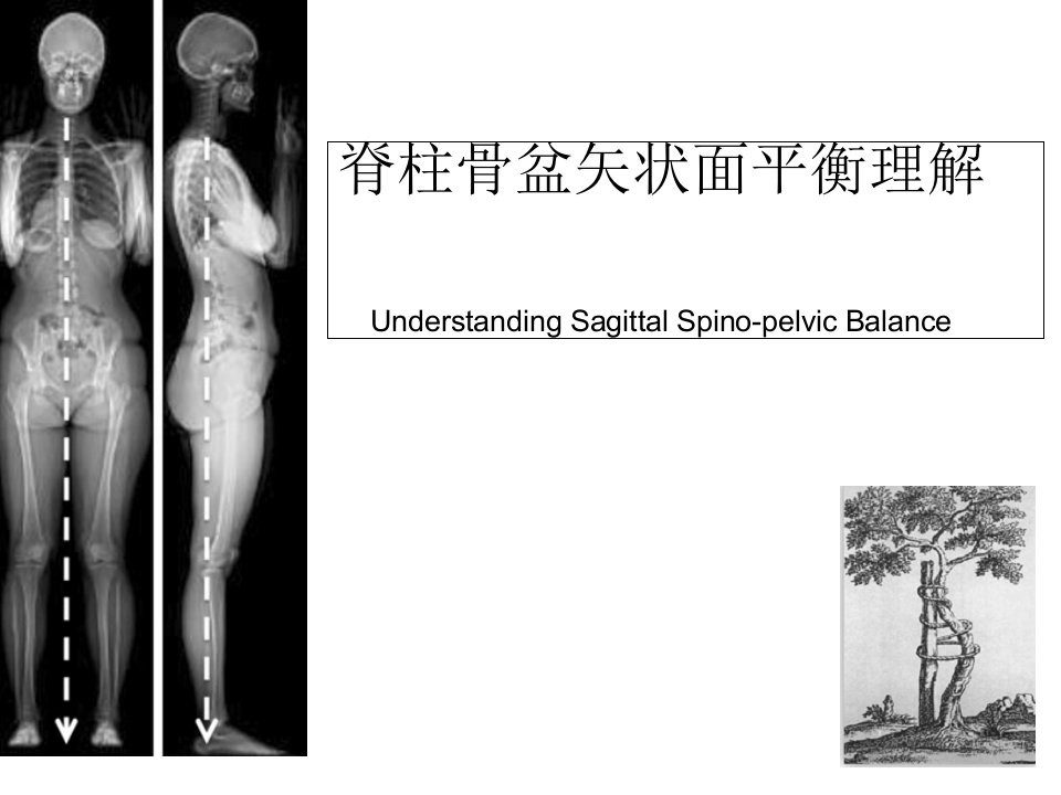 脊柱骨盆矢状面平衡理解课件