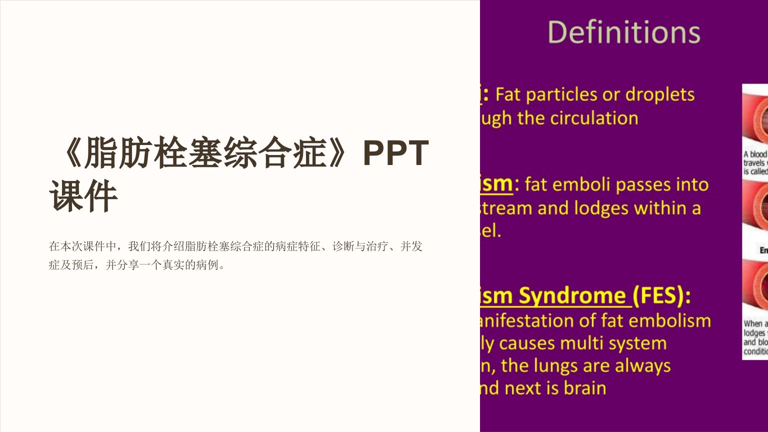 《脂肪栓塞综合症》课件