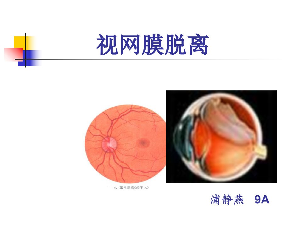 小讲课视网膜脱落课件