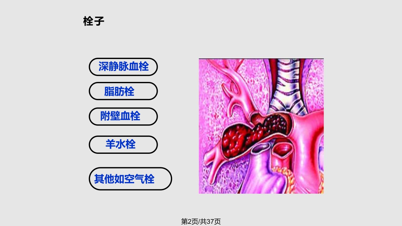 肺栓塞课件学习