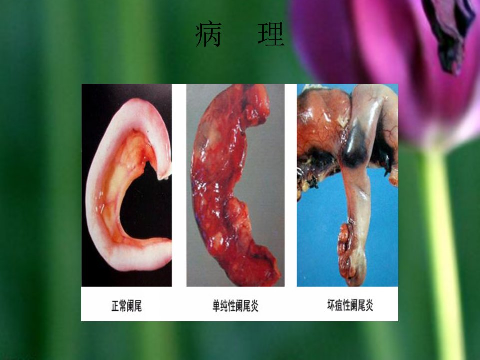 腹腔镜下阑尾切除术护理