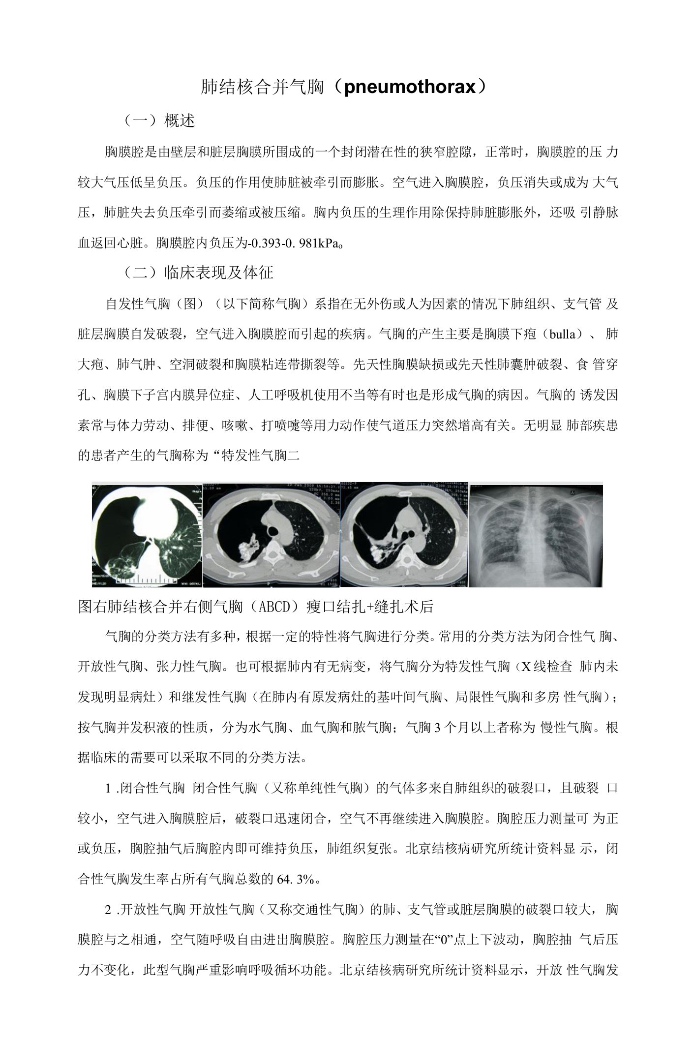 肺结核合并气胸(pneumothorax)的诊断和治疗