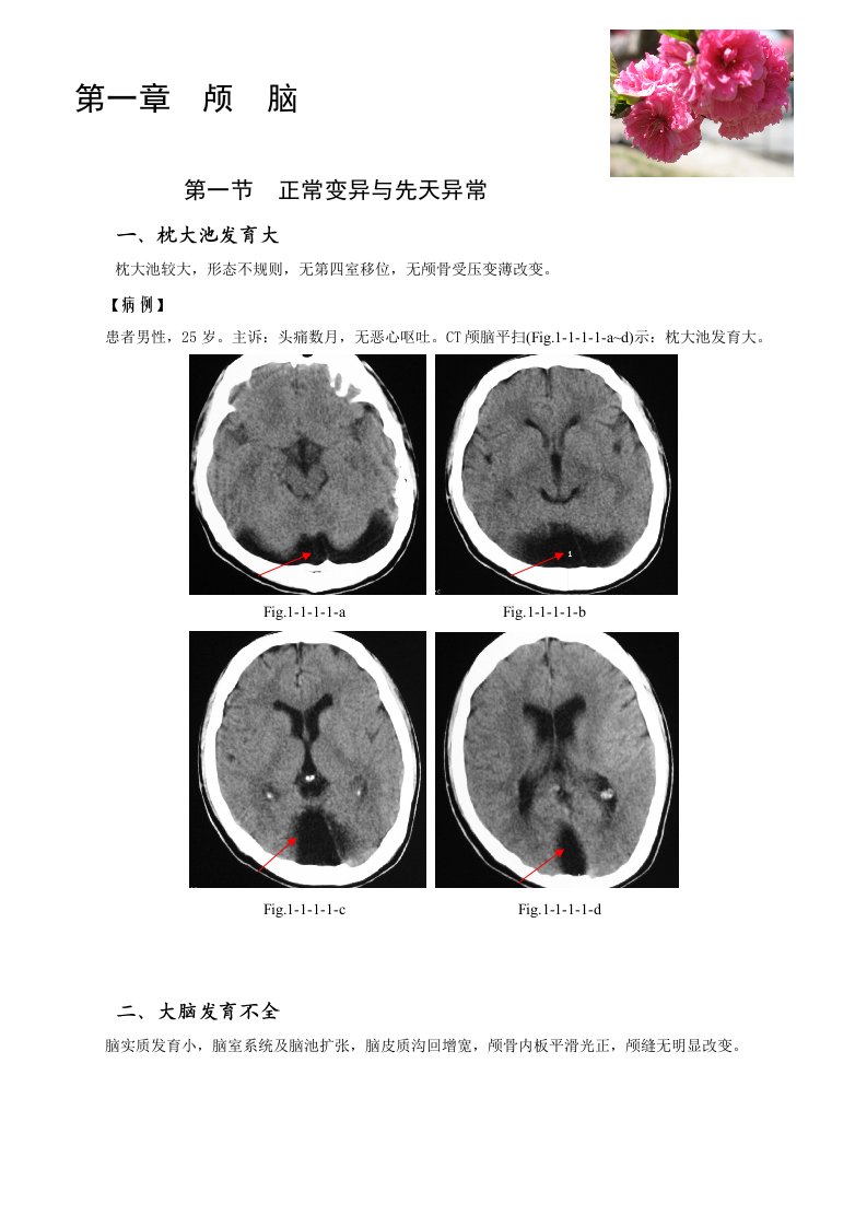 CT典型病例