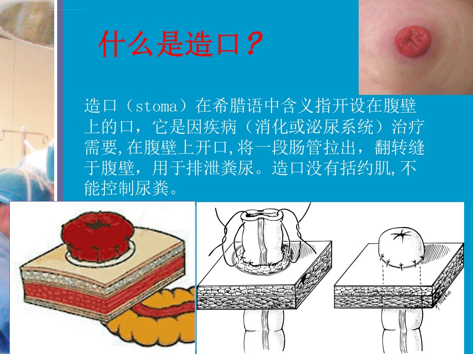 肠造口护理ppt课件